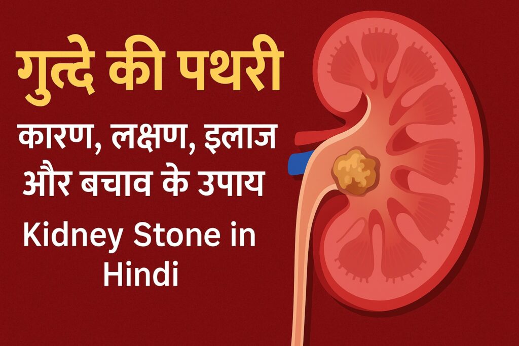 Kidney Stone