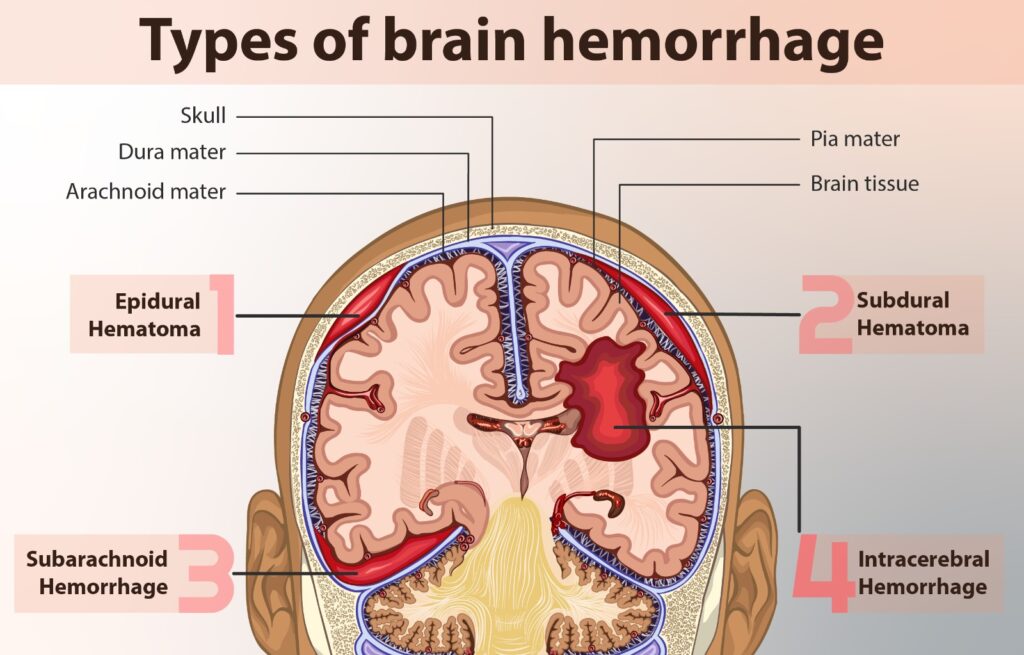 What is a brain haemorrhage