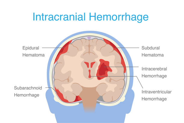 What is a brain haemorrhage