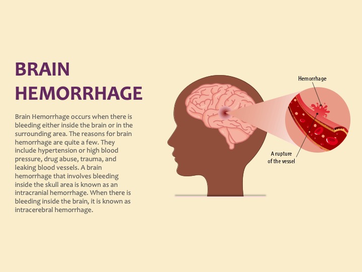Sudden brain hemorrhage