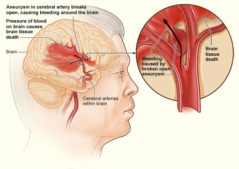 Sudden brain hemorrhage