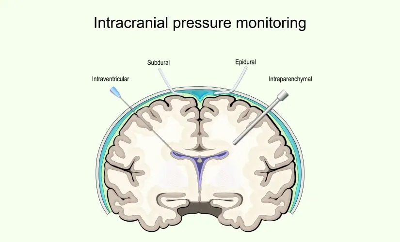 Sudden brain hemorrhage